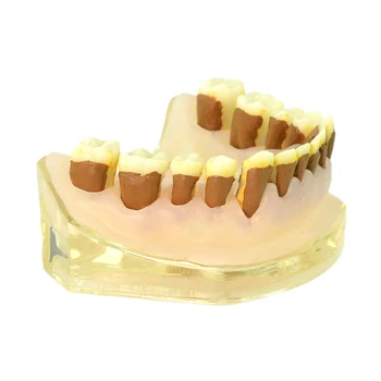 Модель зубов зубов Пародонтоз Модель зубов Модель пародонтита Модель коммуникации со стоматологом
